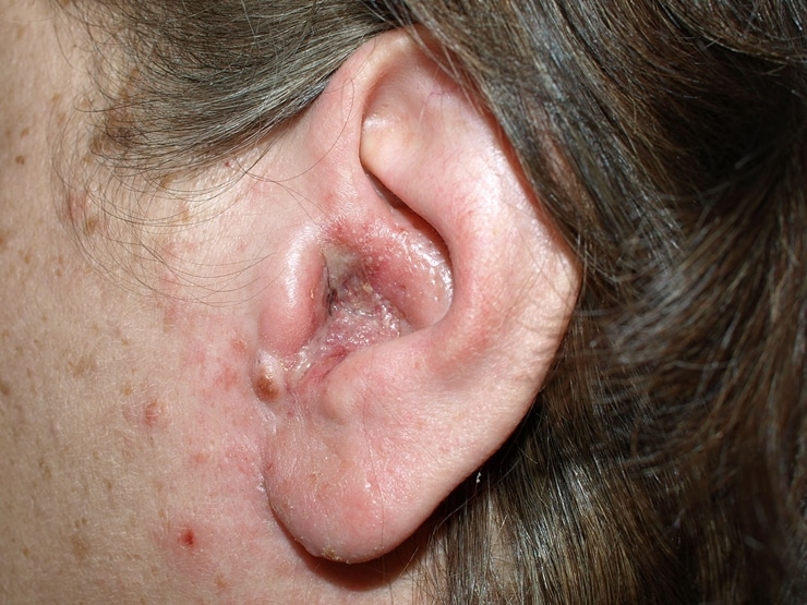 Otitis_externa