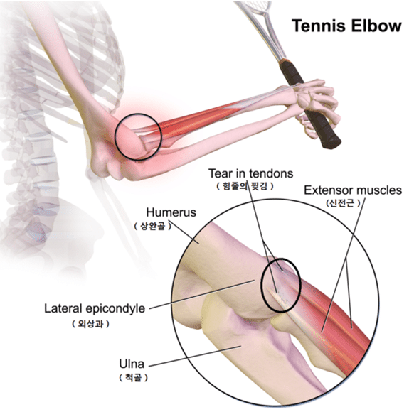 Tennis_Elbow