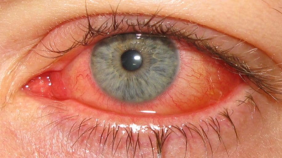 keratoconjunctivitis_epidemica_2