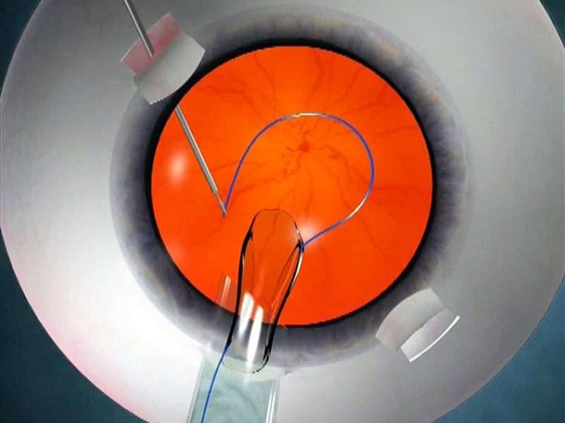 animation_showing_glued_iol_surgery