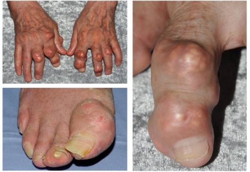 tophaceous_gout