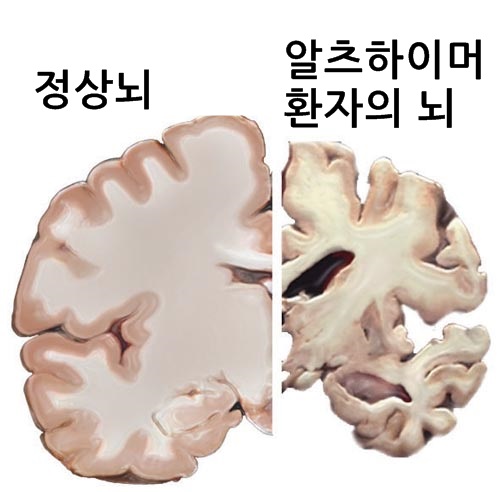 알츠하이머 환자의 뇌