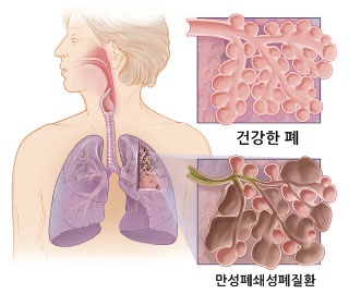 COPD lung