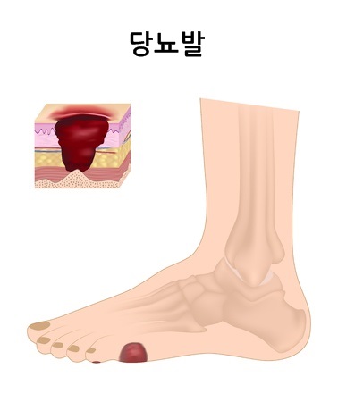 당뇨발