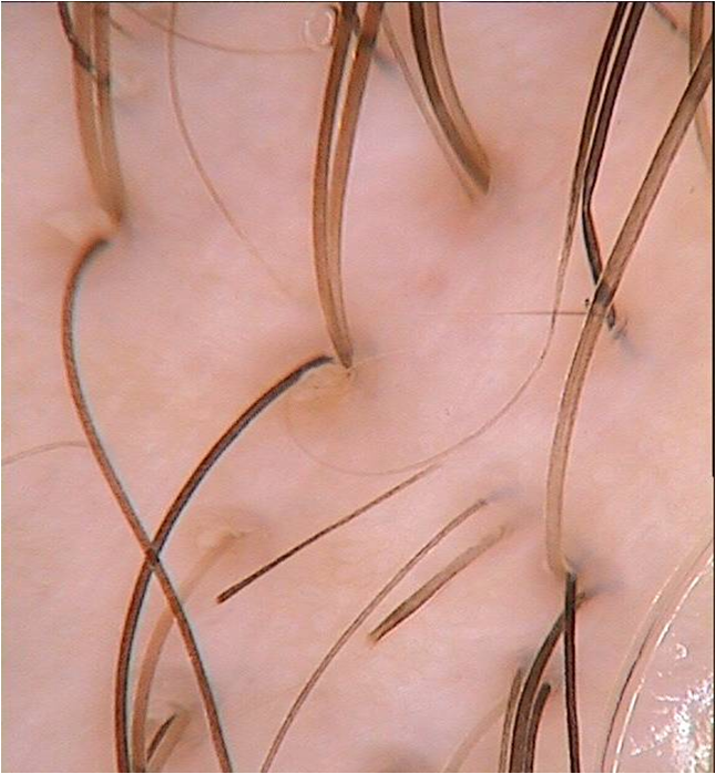 Trichoscopy_AA