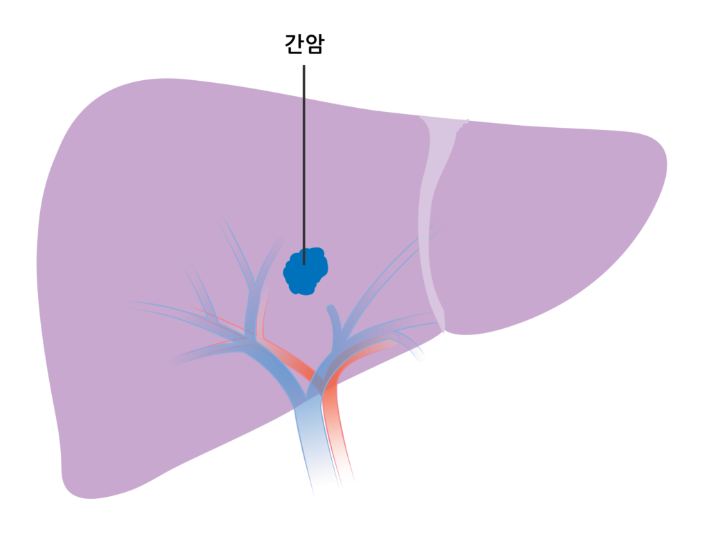 Diagram_showing_stage_1_liver_cancer_CRUK_426.svg