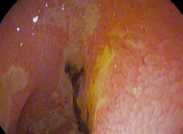 Duodenal_ulcer02