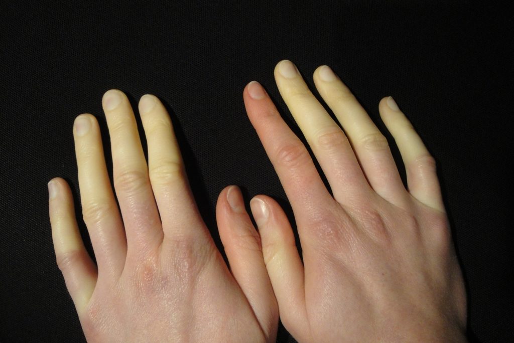 레이노 증후군 Raynaud Syndrom