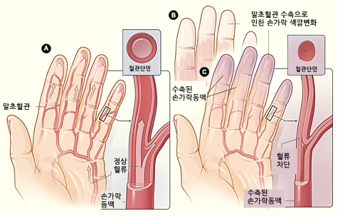 레이노 증후군 기전