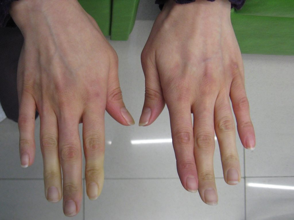 Secondary_Raynaud