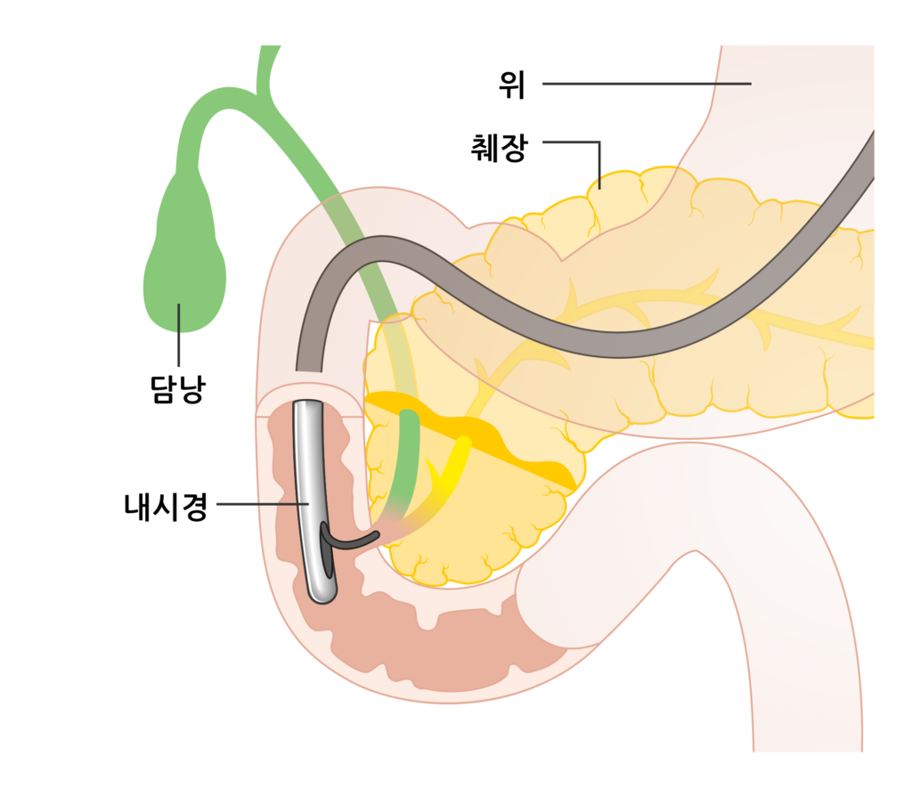 ERCP 역행성 췌담관 내시경검사