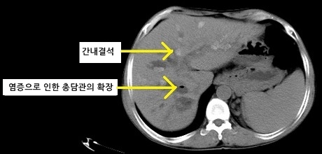 담관염 CT 소견