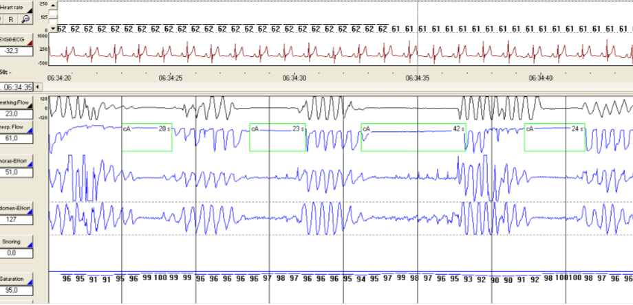 Polysomnography, 수면다원검사